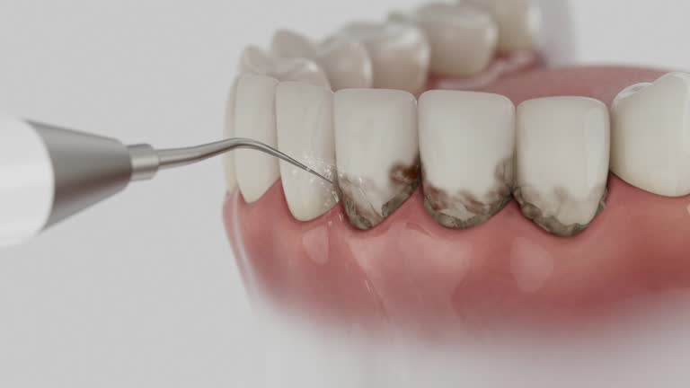 Trusted Wisdom Tooth Removal service in Union, KY - Dentist Open Now